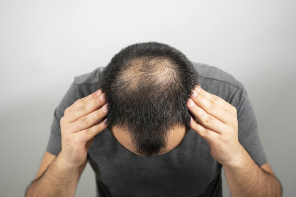 As prostaglandinas apresentam-se como uma nova alternativa de tratamento para a alopecia androgenética (AGA), ou calvície masculina.