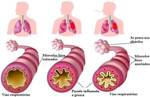 Tratamento para alergia: principais causas, sintomas e como tratar Tratamento para alergia: principais causas, sintomas e como tratar