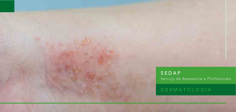 Uso de Melatonina em Crianças com Dermatite Atópica