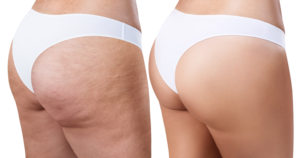 Tratamento da Celulite - Estratégias com Ação na Fibrose do Tecido Conjuntivo