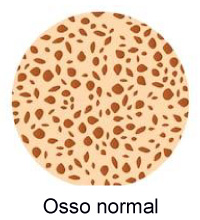Citrato de Potássio é Eficaz na Osteopenia em Mulheres Pós-Menopausadas