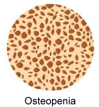 Citrato de Potássio é Eficaz na Osteopenia em Mulheres Pós-Menopausadas