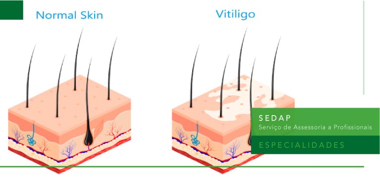 Update de Tratamento no Vitiligo