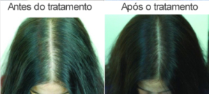 Novas Evidências Comprovam a Eficácia da Finasterida na Alopecia Padrão Feminino