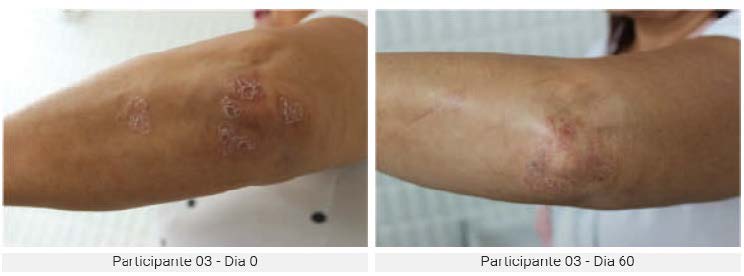 Nova Água Termal com Efeitos Benéficos no Gerenciamento da Psoríase